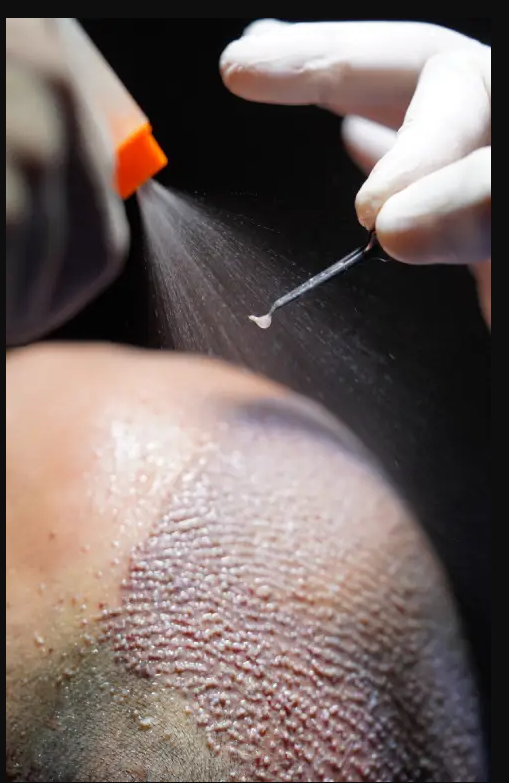 Hair Transplant in Delhi