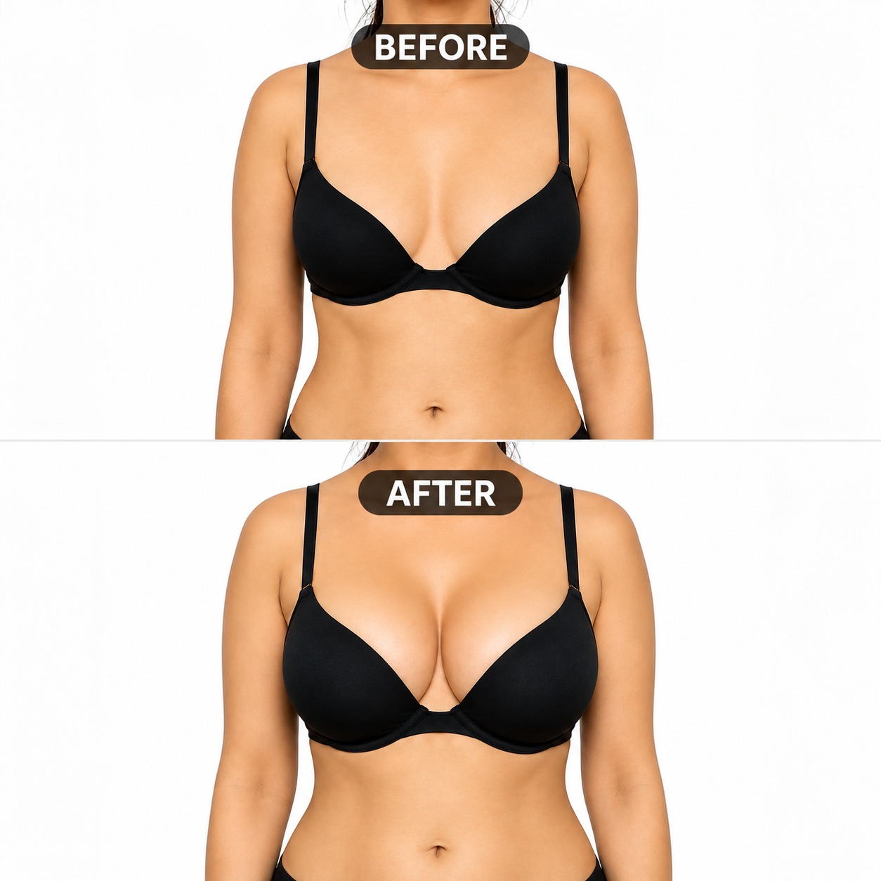 Breast enhancement before and after result at MS Hair & Skin Care Delhi