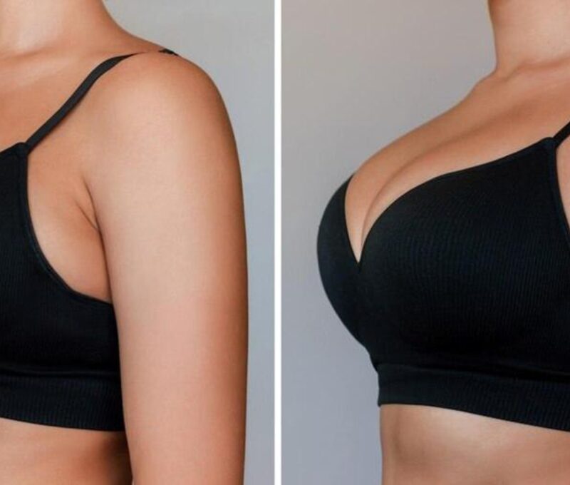 Breast Augmentation in Delhi
