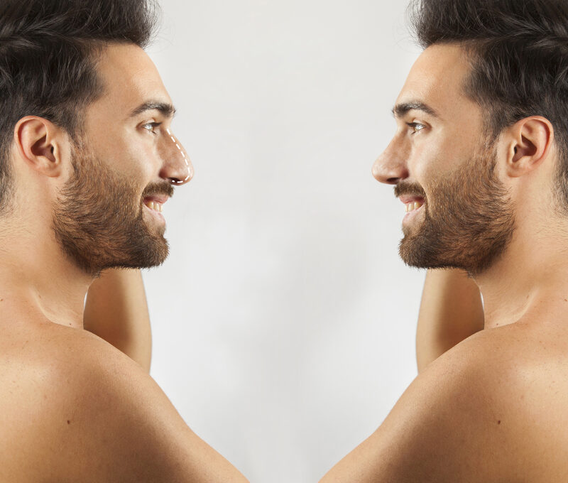 Botox for men Delhi