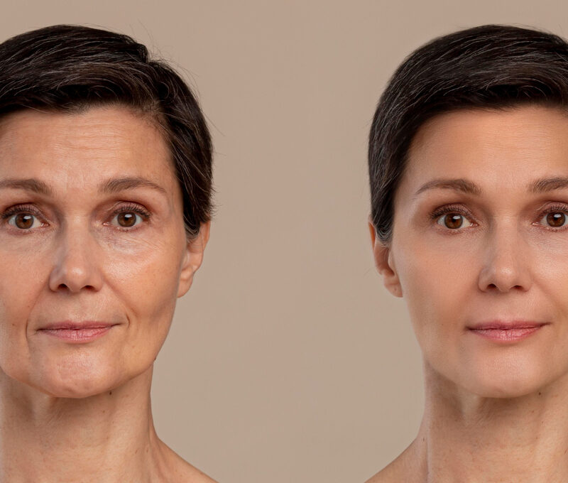 Radio frequency body contouring Delhi