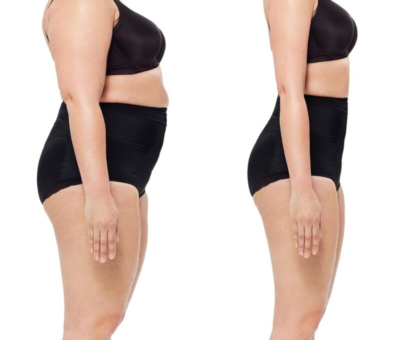 Tummy tuck abdominoplasty Delhi