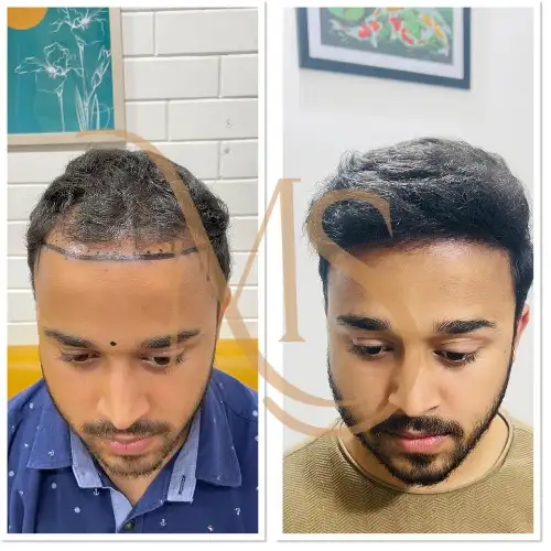 Hair Transplant Before After Result 1 - MS Skin Clinic Delhi