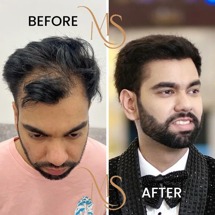 Hair transplant cost, recovery and results guide for Delhi patients