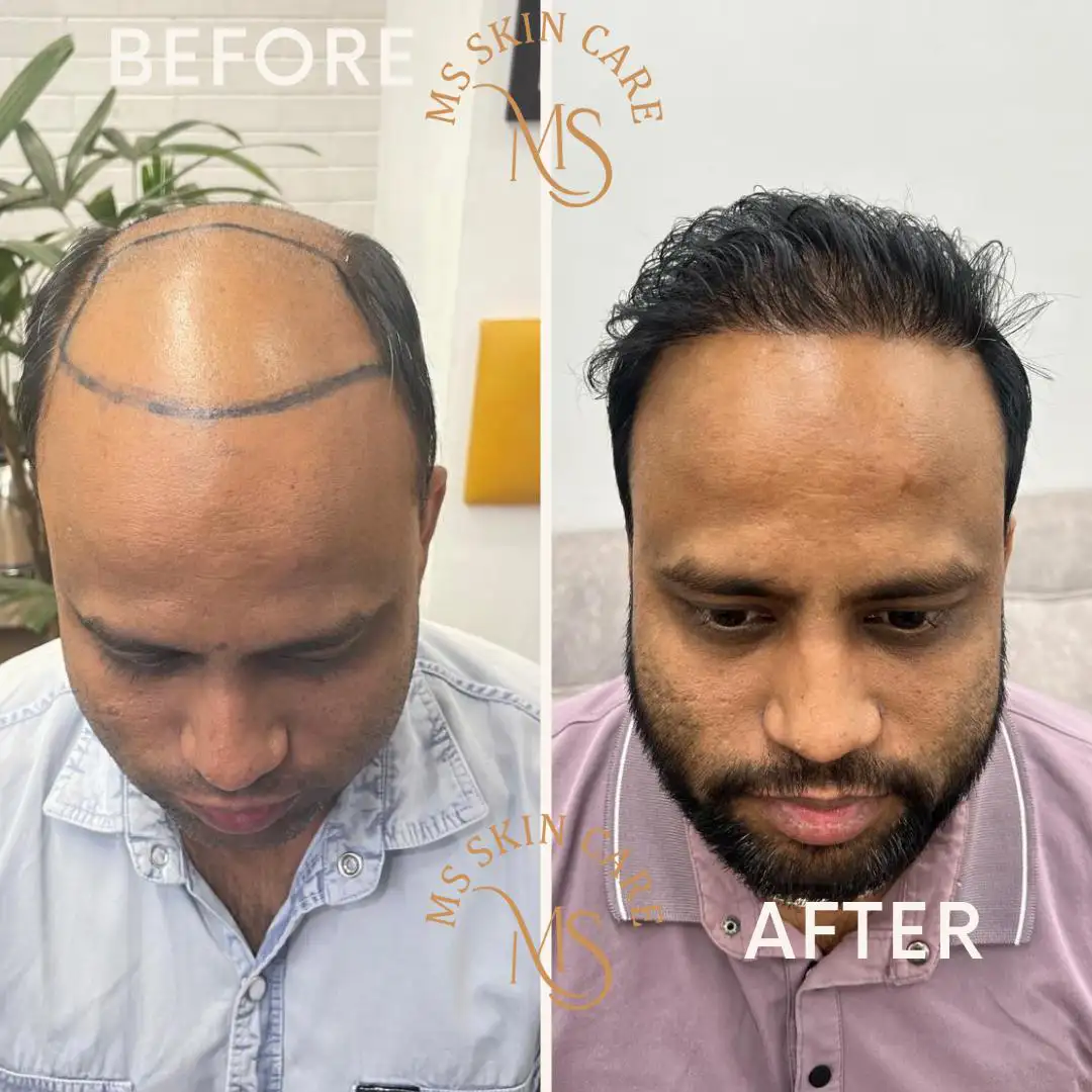 Hair Transplant Before After Result 2 - MS Skin Clinic Delhi