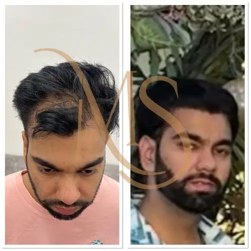 Hair Transplant Before After Result 3 - MS Skin Clinic Delhi