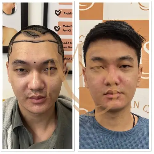 Hair Transplant Before After Result 4 - MS Skin Clinic Delhi