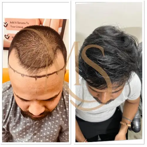 Hair Transplant Before After Result 5 - MS Skin Clinic Delhi