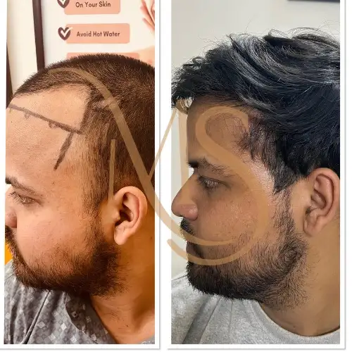 Hair Transplant Before After Result 6 - MS Skin Clinic Delhi